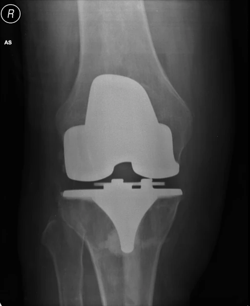 Knee Implant